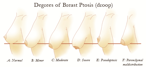 breast droop